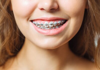 What is a Gummy Smile and How Can Braces Treat A Gummy Smile?