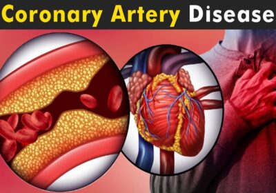 Lifestyle Adjustments to Lower Your Risk of Coronary Artery Disease