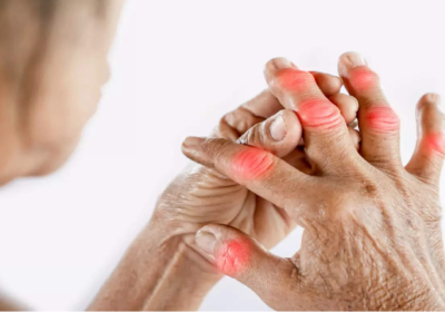 How To Prevent Arthritis? – 5 Key Tips