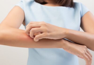 How to Deal with Skin Allergies Effectively?