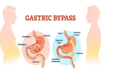 How to check if I can go for a gastric bypass?