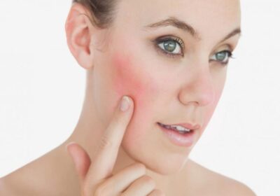 Things You Need To Know About Rosacea