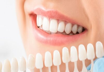 Smile Bright With White Dental Crowns